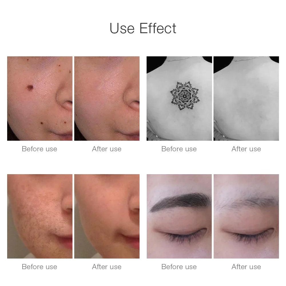 Neatcell™ – Pikosekunden-Laser zur Entfernung von Tattoos & Pigmentflecken