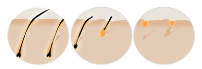 HexoSkin™ At-Home IPL-Laser-Haarentfernungsgerät