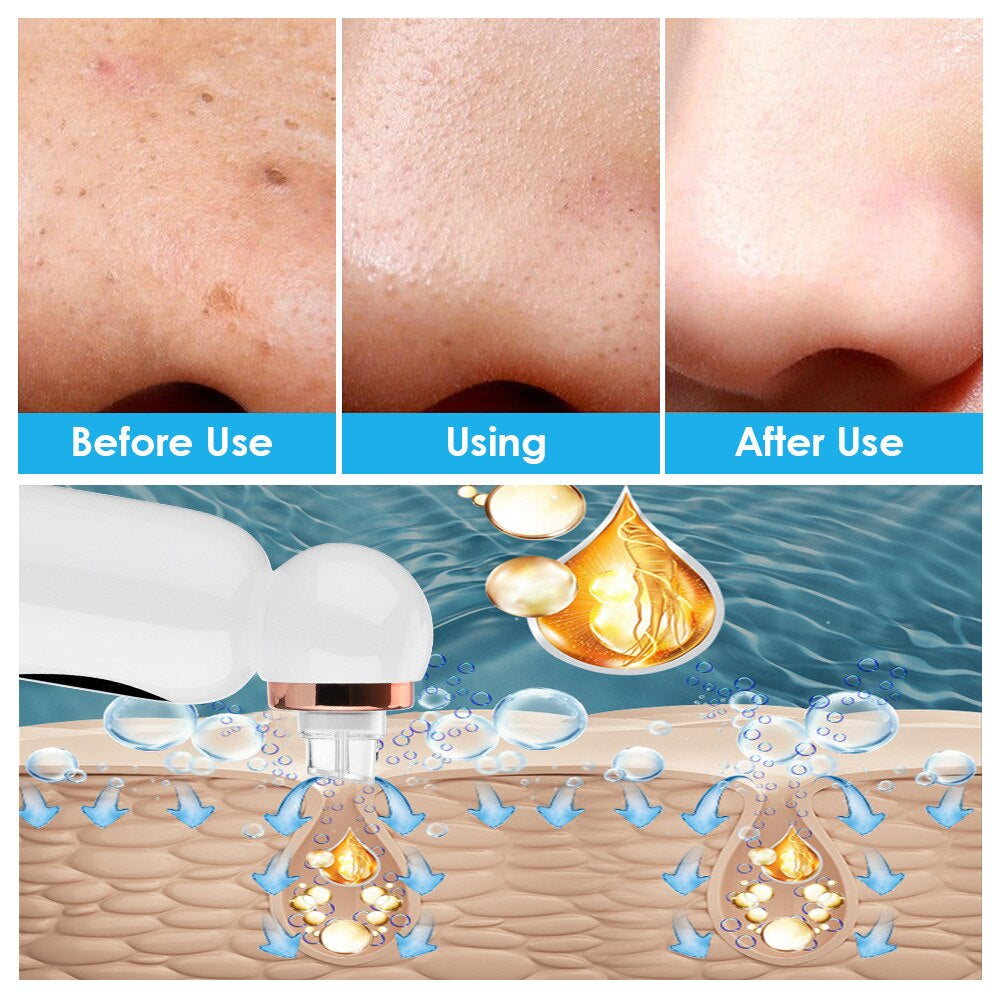 HexoSkin™ Hydrodermabrasion Mitesserentferner