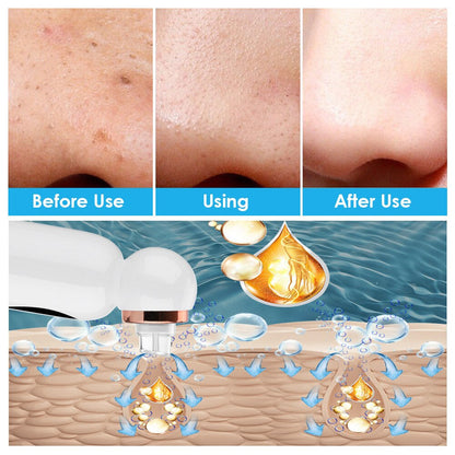 HexoSkin™ Hydrodermabrasion Mitesserentferner