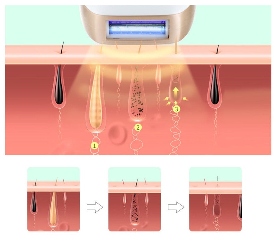 HexoSkin™ IPL-Laser-Haarentfernungsgerät