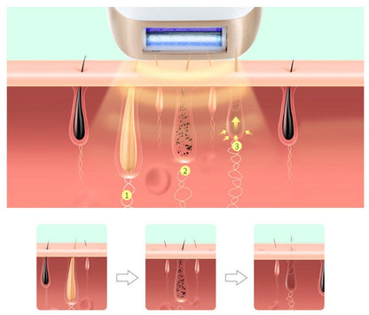 HexoSkin™ IPL-Laser-Haarentfernungsgerät
